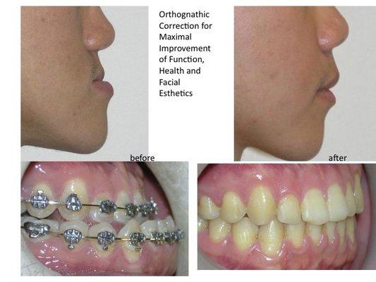 Case zr. Facial esthetic Improvement after surgery. (provided by Hu Lin Orthodontics, copyright © 2017. All rights reserved)胡林牙齿矫正专科