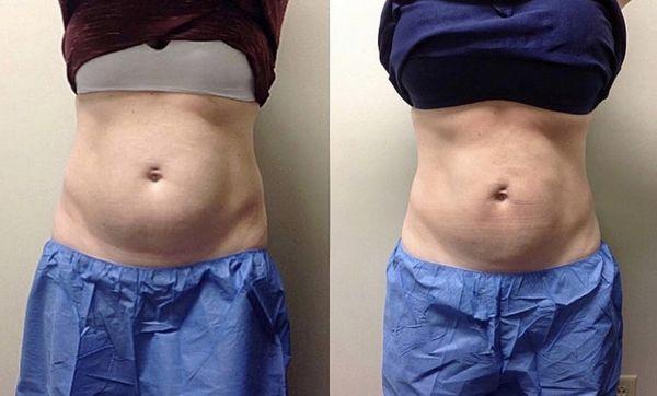 CoolSculpting before and after