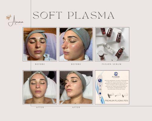 Soft plasma acne/blemishes treatment