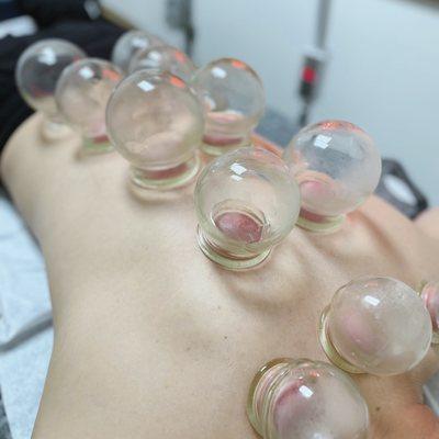 Dry cupping for back tension & pain