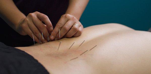 #lowbackpain #acupuncturetreatment