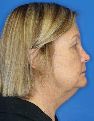 69 year-old patient before facelift