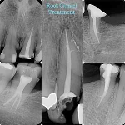 Root Canal treatment