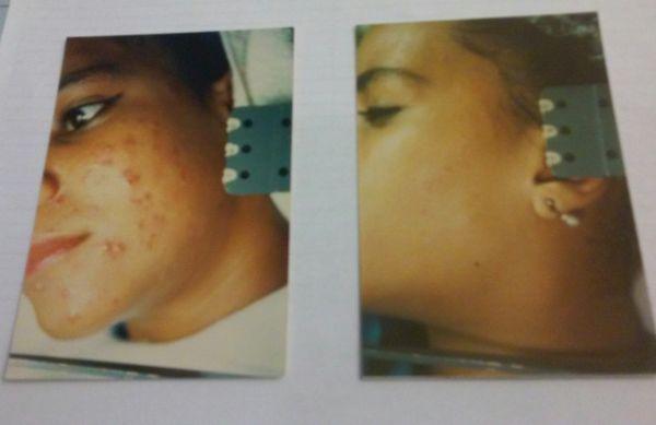 BEST TREATMENT FORE ACNE LORENZ 305 4428007