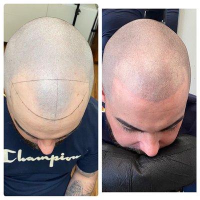 Receding hairline no problem. Scalp micro pigmentation is undetectable and affordable.