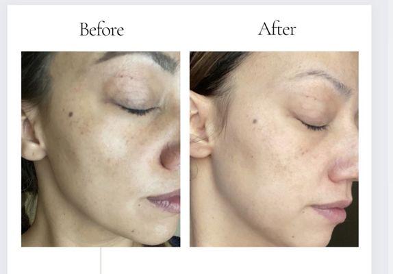 This was just after my first treatment and TriBella included three treatments! So worth it!