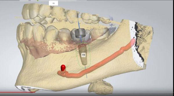 Digital Implant Planning