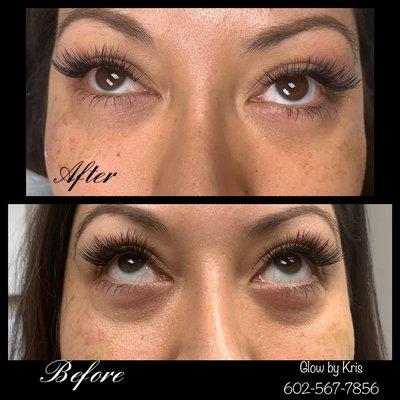 Bright & Beautiful Under Eye Procedure!