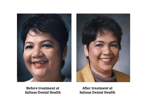 Before and After of a Salinas Dental Health patient