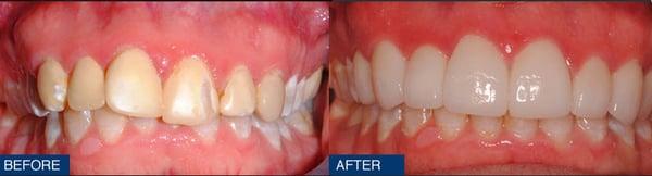 This gentleman was unhappy with his "bonding" and crooked teeth.  Veneers solved both problems.