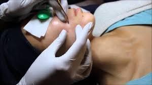 Deep pore facial extraction