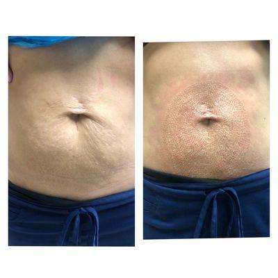 Skin tightening using plasma pen fibroblasting!