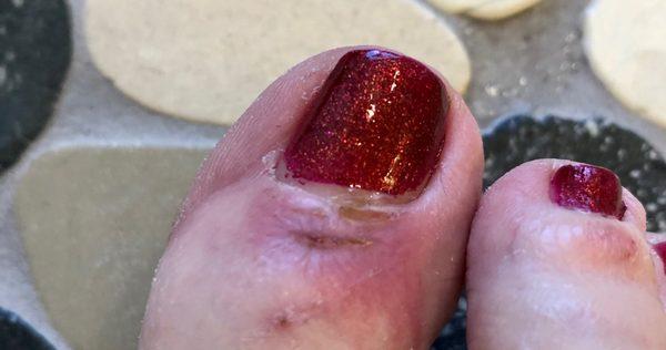 This damage done to my big toe is 9 days old....it is still healing slowly!