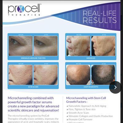 ProCell Therapies Microchanneling Service Before & After.