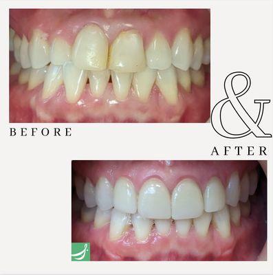 Invisalign and four veneers transform this smile.