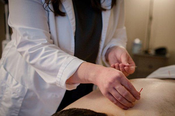 Specific acupuncture points are used to assist in promoting blood circulation, balancing the body, and promoting natural healing.