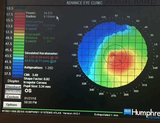 Cool map of my eye!