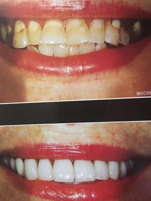 Porcelain Crowns by Dr. Asadi