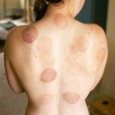 Cupping therapy benefits beyond  back pain and neck pain. Cupping in 90025