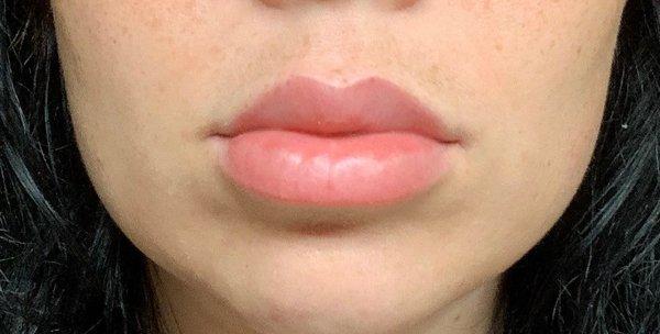 This is how my lips look currently. You can see what a difference from the first photo. It's just insane!