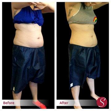 Strella Coolsculpting before and after image