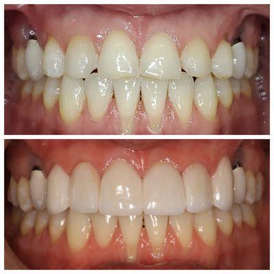 Before and after. Another happy patient