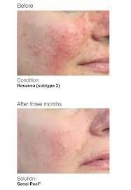 Rosacea before/after Sensi peel