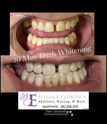 30 min teeth whitening $60