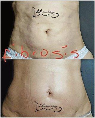 FOR MORE INFO VISIT LAMASSAGEBYDESIGN.COM OR CALL (954) 736-9035 the difference between post surgical massage after a lipo and not doing the