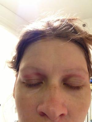 Eye lid Burn from wax used during eye brow wax.