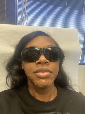 Laser Hair Removal to the chin