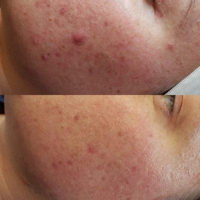 Two Microdermabrasions with Mandelic Peel