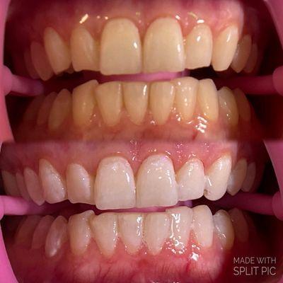 Teeth whitening service. Before and after