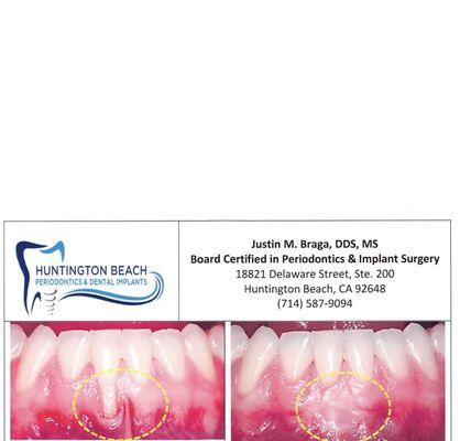 Gum Grafting results