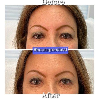 Eyes deserve to be open! The power of properly placed Botox!