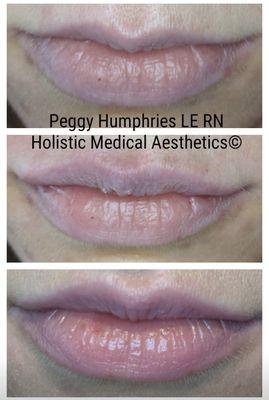 Lip Filler to enhance and restore shape and volume