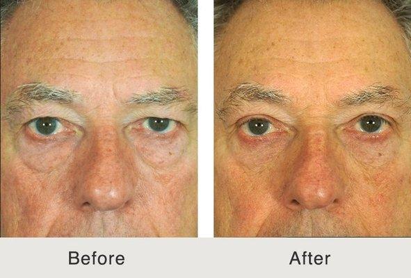 Blepharoplasty for droopy looking eyes