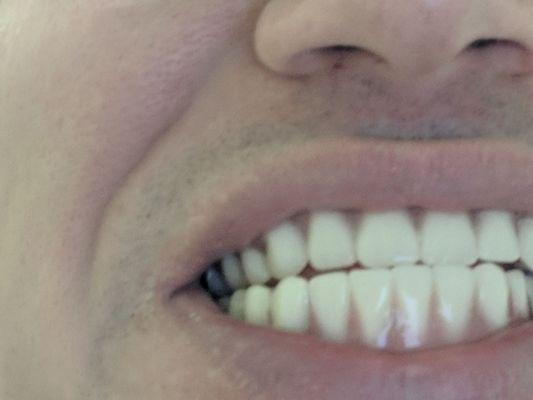 Example of poor fit. Notice that the bottom and top teeth Don't line up together