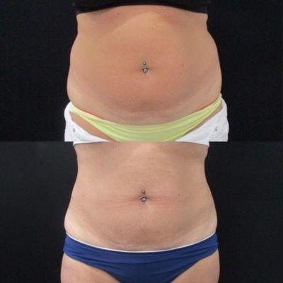 Coolsculpting Results