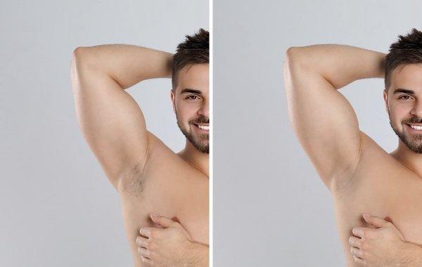 Before and after laser hair removal