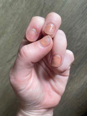 What I've had to do to keep my nails from literally falling off my fingers 11 days later