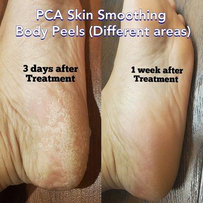 Pca Skin Body Peels!.
Call us for more information.