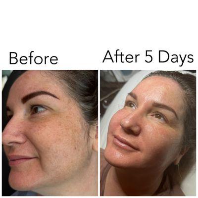 This peel has amazing results. Don't live with hyperpigmentation.  Book today