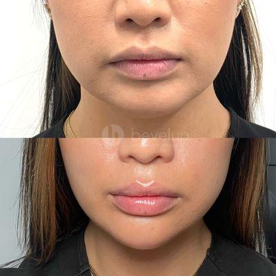 Before and after photo of chin and lip filler for facial balancing