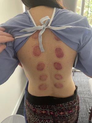 Cupping