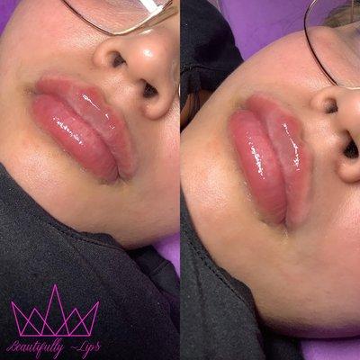 Hyaluronic acid lip fillers