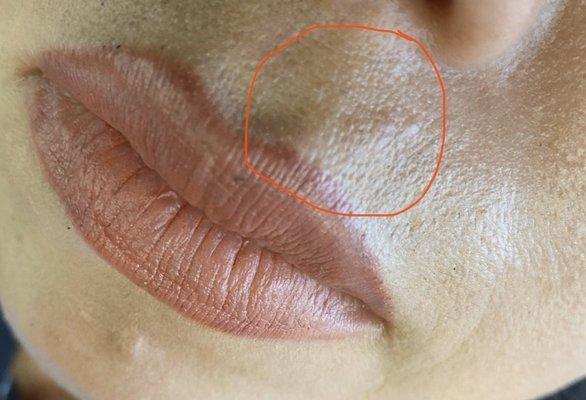 Lump formed after lip injections