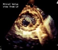 3D echocardiography image of the mitral valve viewed from the left ventricle.