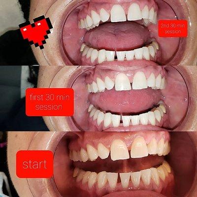 Teeth whitening