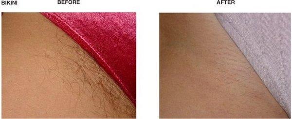 Permanent hair removal